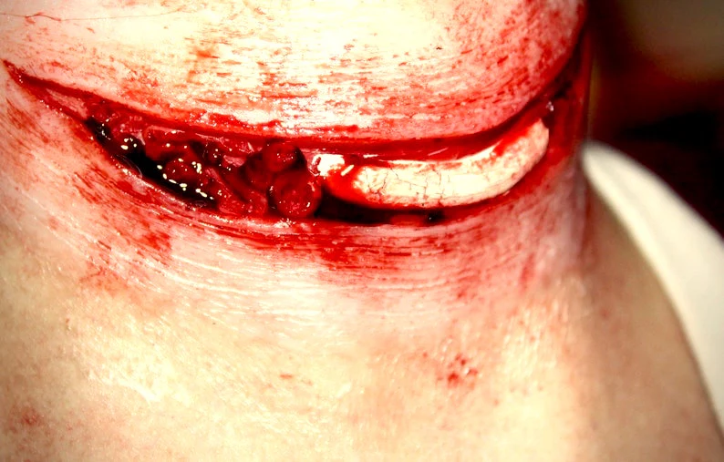 Exposed Slit Throat Prosthetic - Image 2